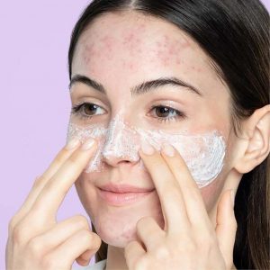 Da mụn và da nhạy cảm có dùng gel rửa mặt được không?
